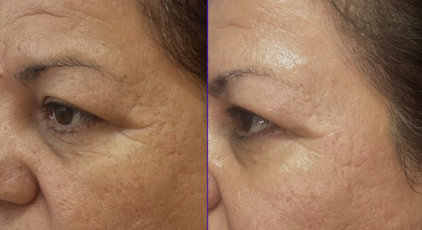 Potenza treatment before and after showing reduced wrinkles