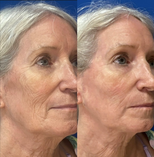 Sculptra treatment before and after comparison