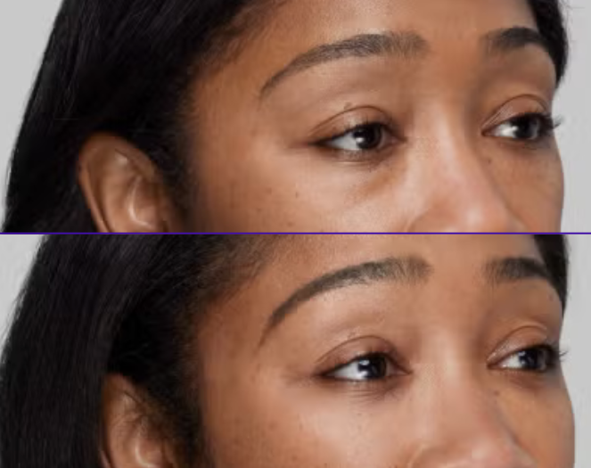 Undereye filler treatment before and after showing reduced dark circles