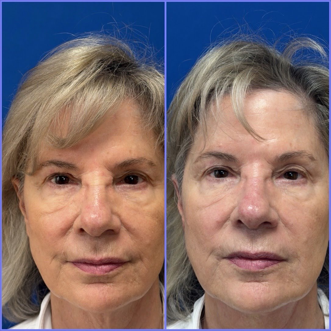 MINT PDO thread lift before and after — full face lifting and rejuvenation