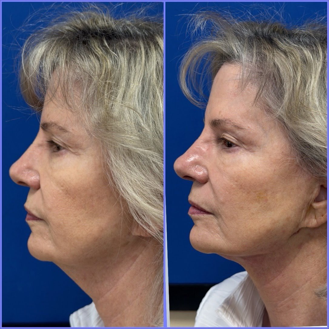 MINT PDO thread lift before and after — jawline and chin definition
