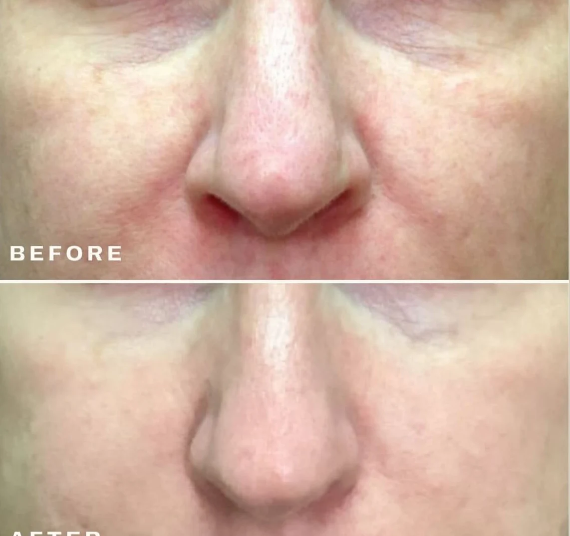 Opus Plasma Treatment before and after result