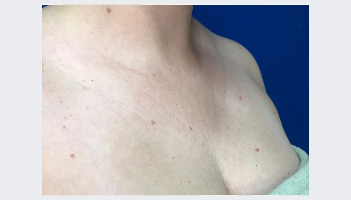 Ashley after Aquafirme Hair Treatment