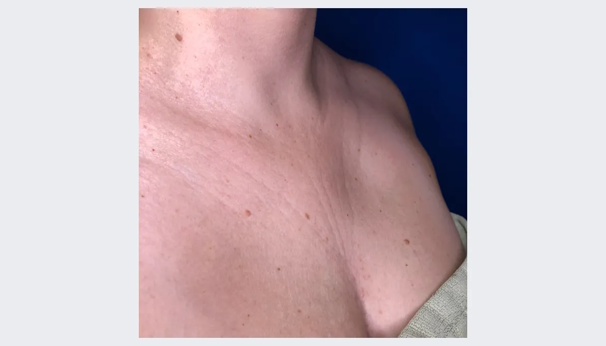 Ashley before Aquafirme Hair Treatment