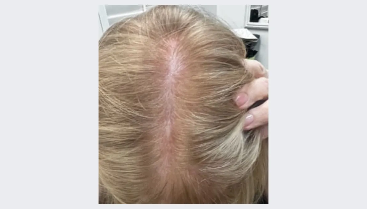 Sharen after Aquafirme Hair Treatment