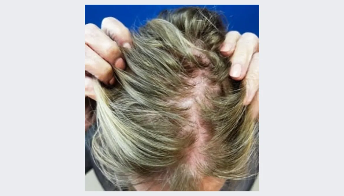 Sharen before Aquafirme Hair Treatment