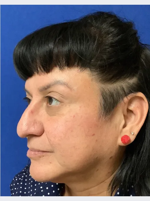 Leeann after Acne Scar Treatment