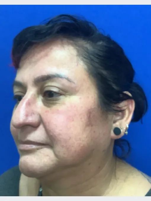 Leeann before Acne Scar Treatment