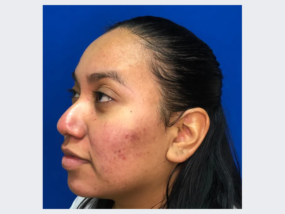 Marisol after Thread Lift Procedure