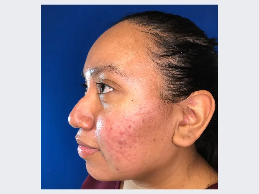 Marisol before Thread Lift Procedure