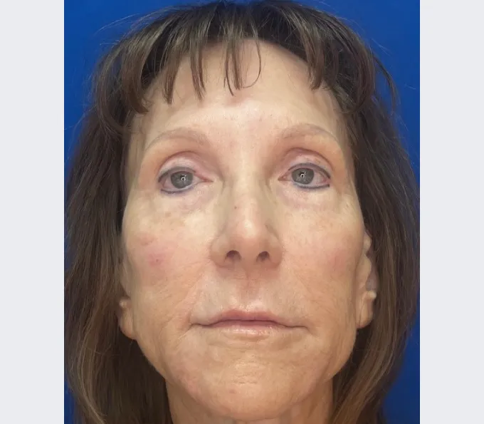 Brenda after Skin Tightening Treatment