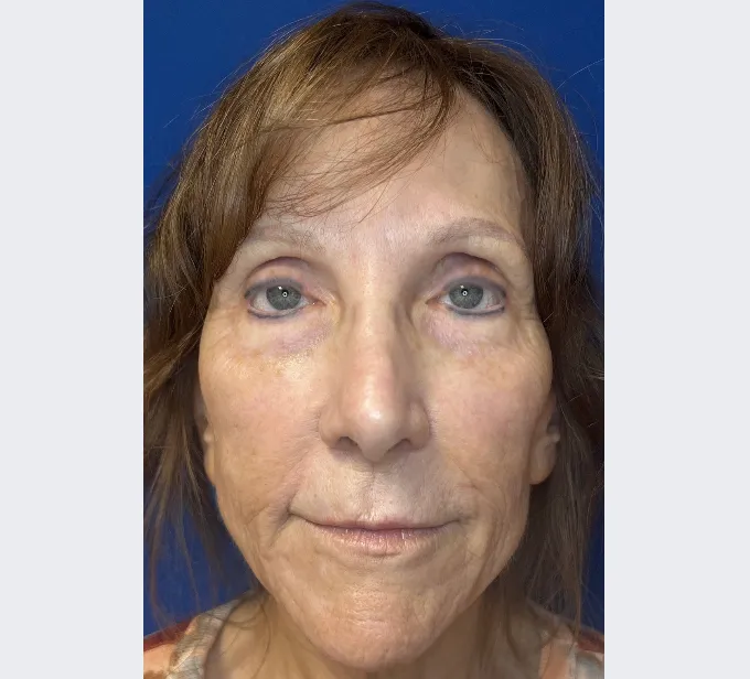 Brenda before Skin Tightening Treatment