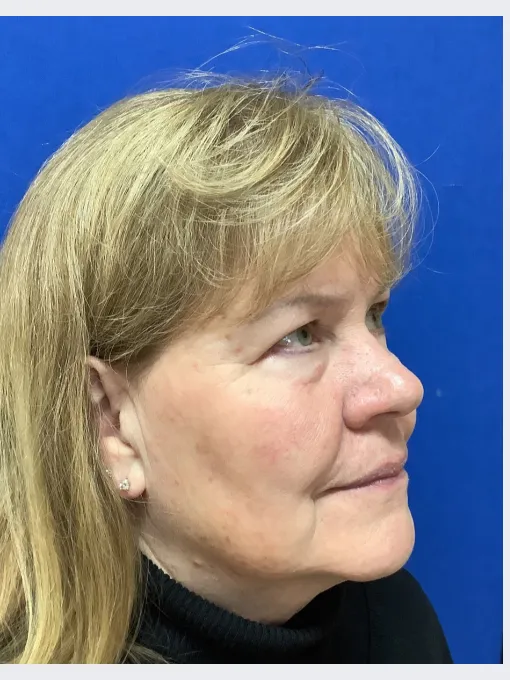 Claudia after Dermal Filler Treatment
