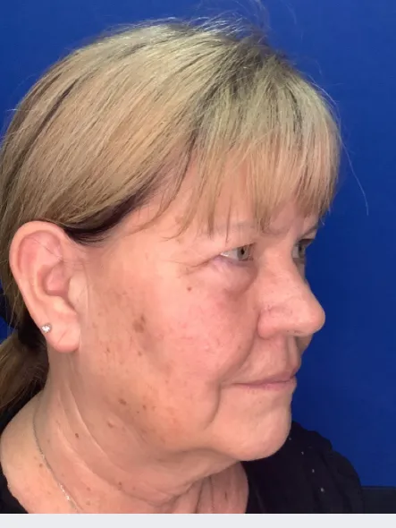 Claudia before Dermal Filler Treatment