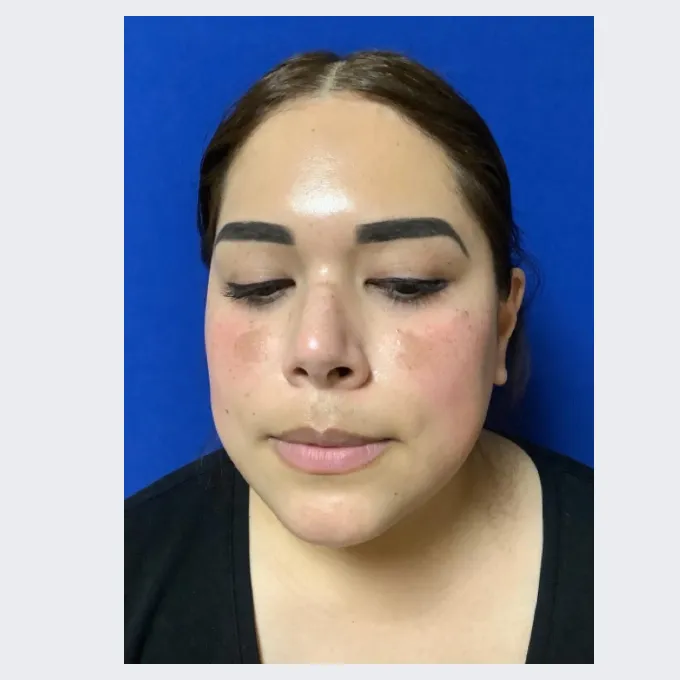 Elizabeth before IPL for Brown Spots