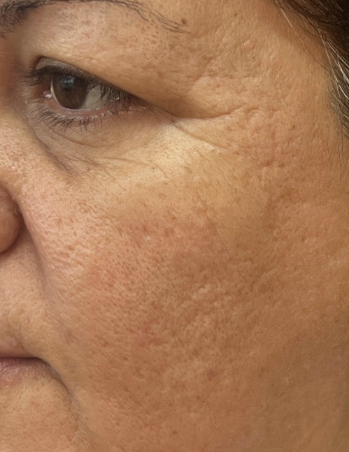 Sara before Opus Plasma Treatment