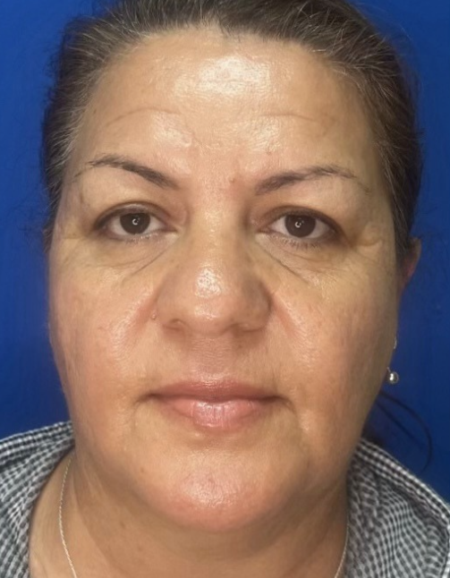 Sara after Opus Plasma Treatment