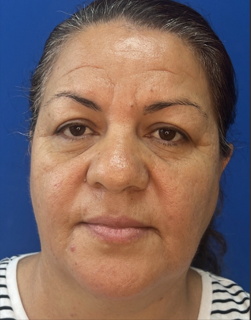 Sara before Opus Plasma Treatment