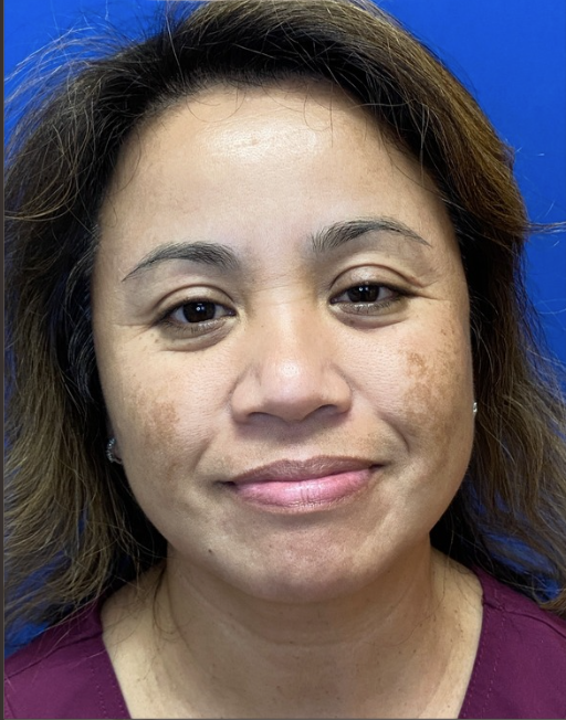 May before PicoSure Laser Treatment