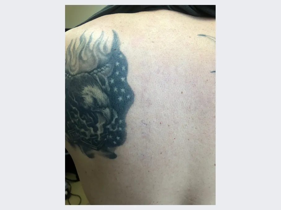 Peter after Laser Tattoo Removal