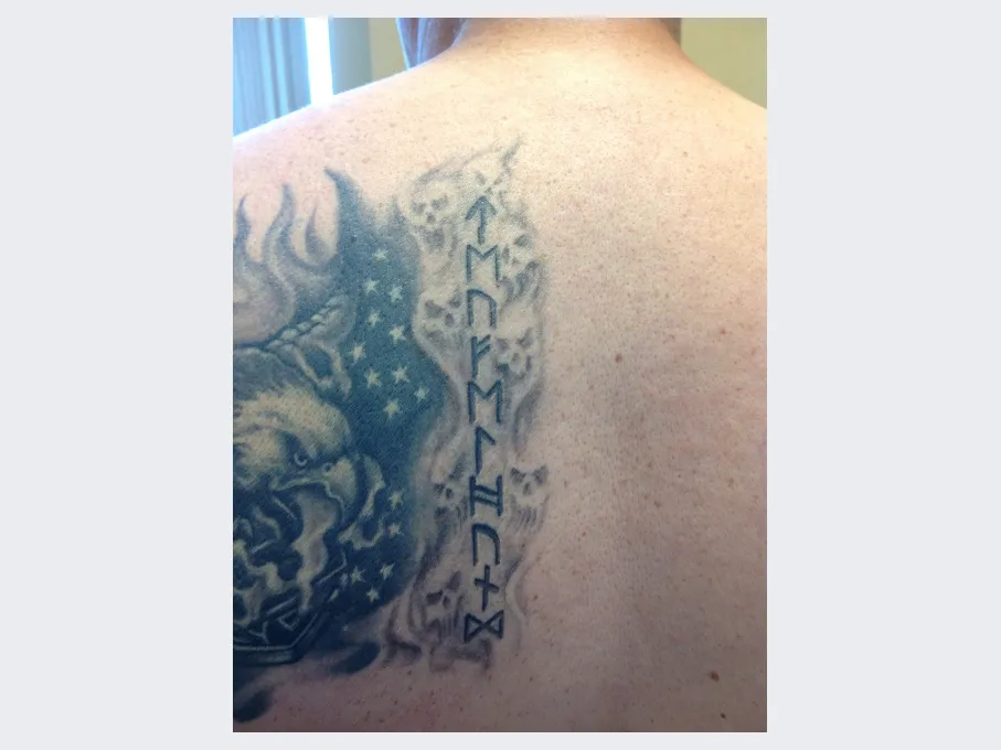 Peter before Laser Tattoo Removal