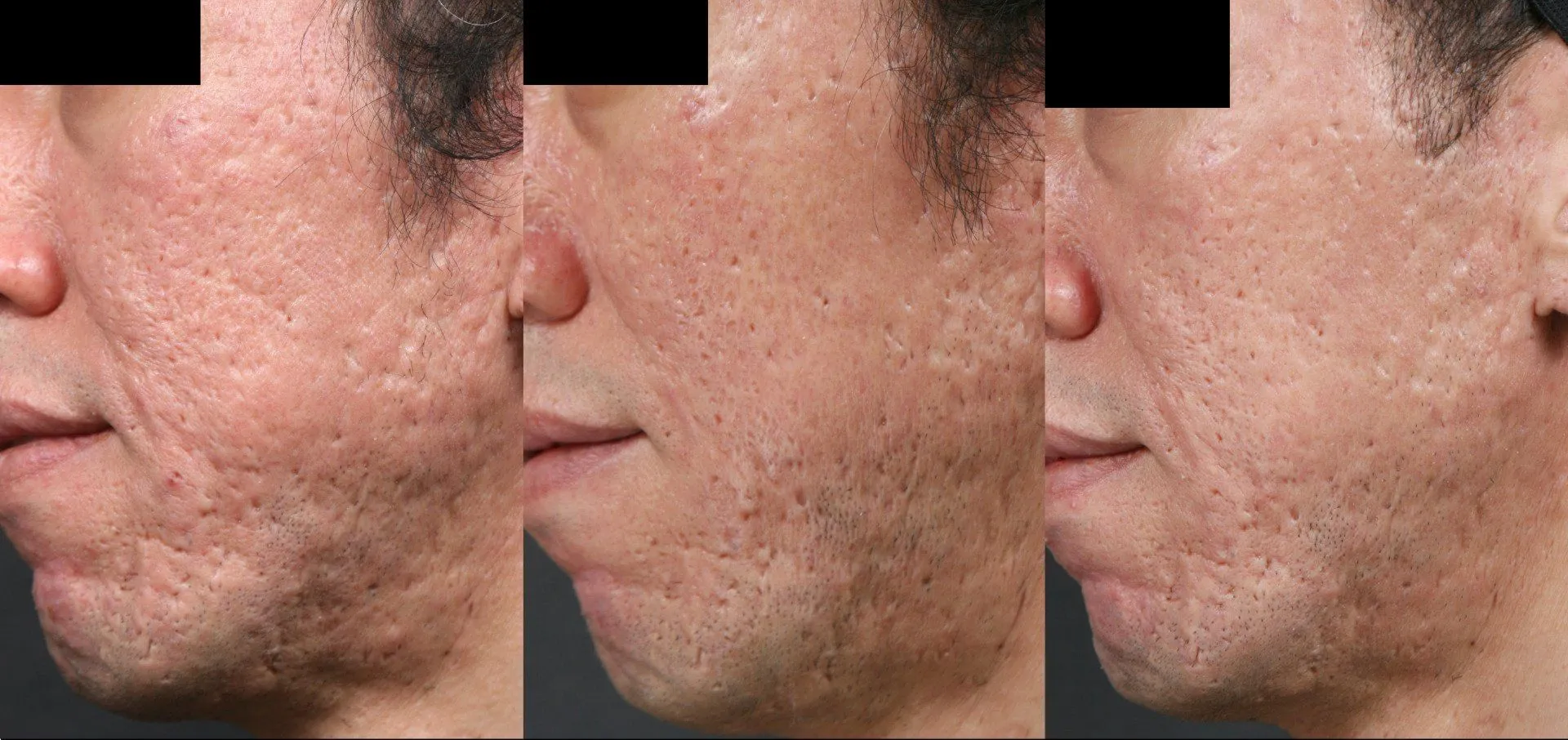 Potenza Before and After Result 1