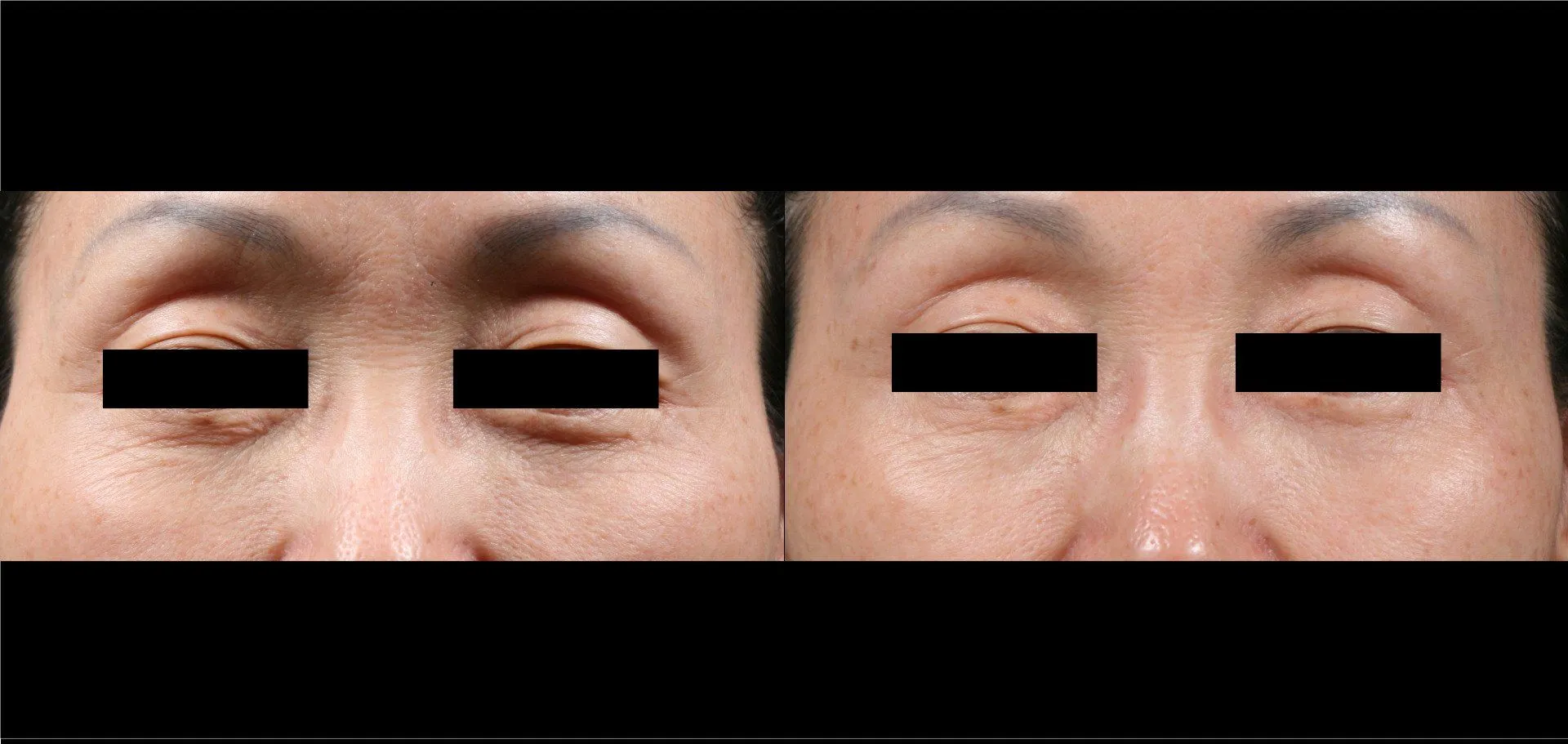 Potenza Before and After Result 2