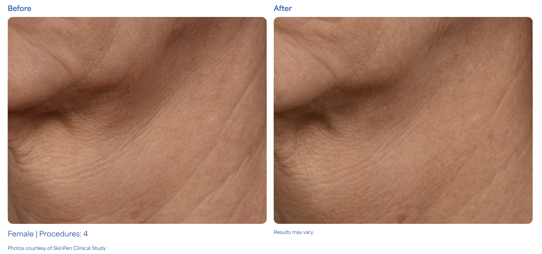 SkinPen microneedling before and after results